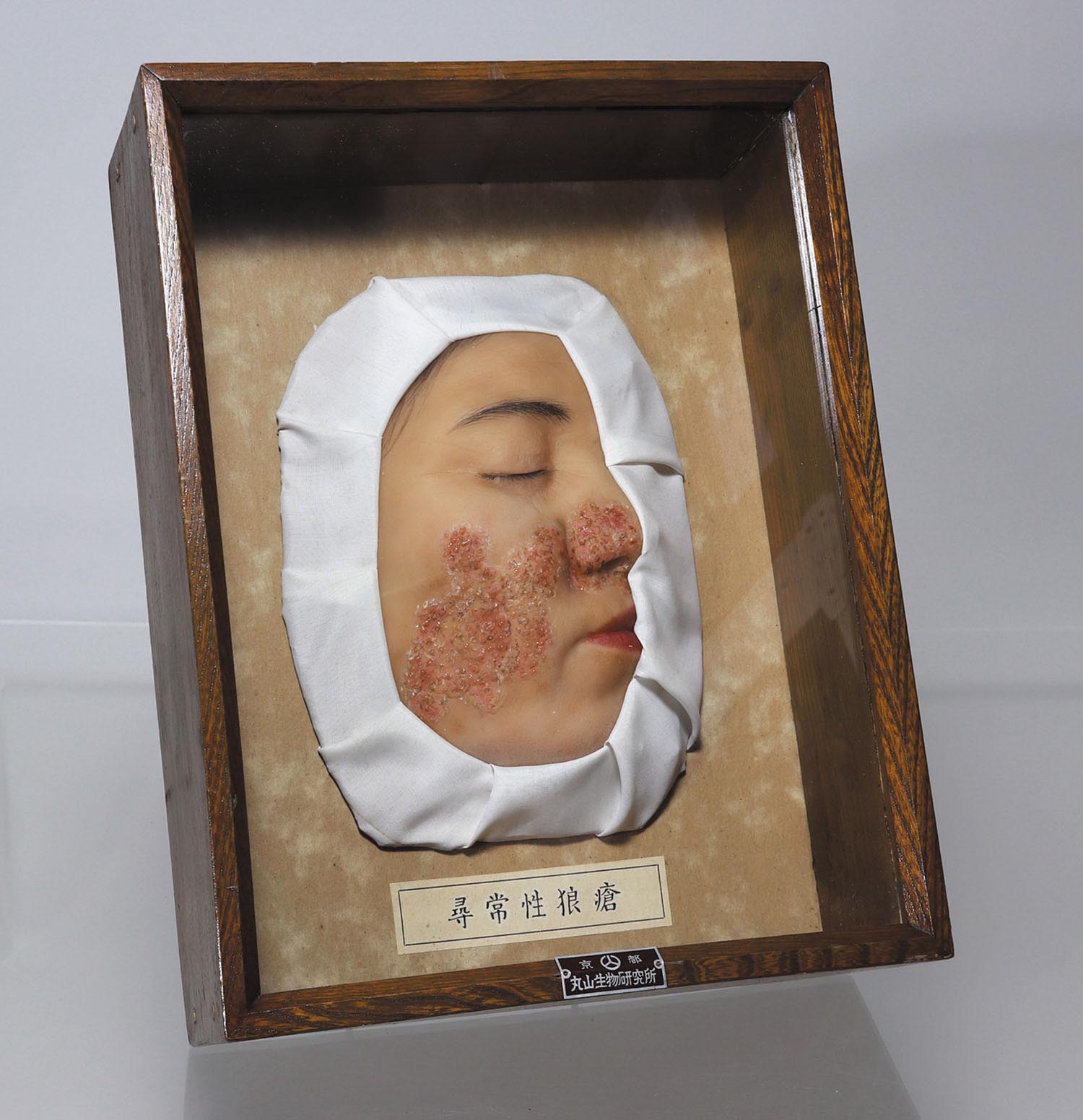 尋常性狼瘡