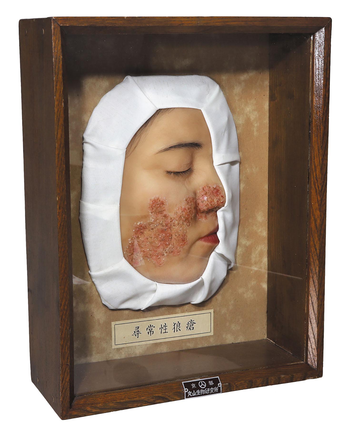 尋常性狼瘡