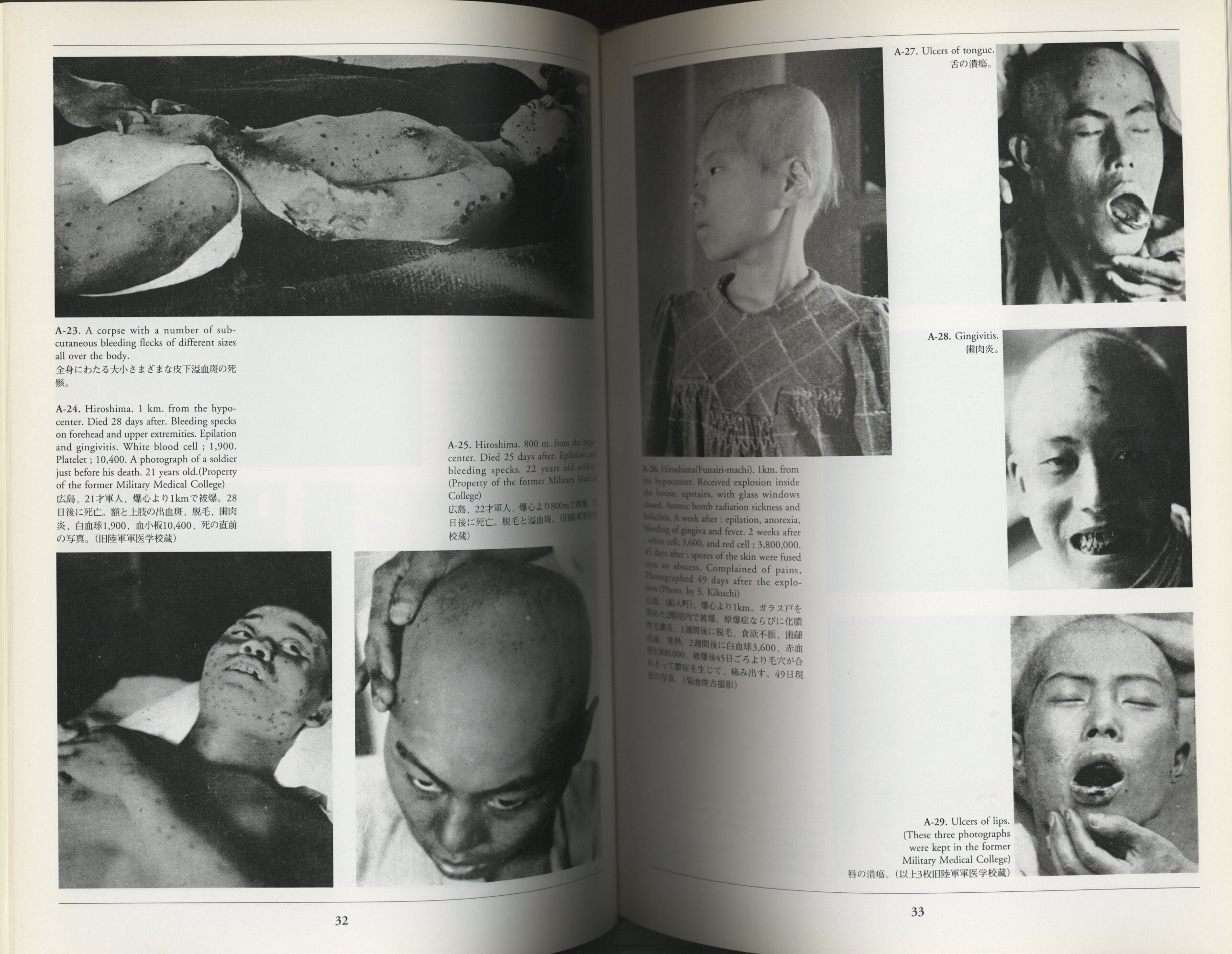 草野信男 原爆症 Atomic Bomb Injuries まんだらけ Mandarake 草野信男 原爆症 Atomic Bomb Injuries まんだらけ Mandarake
